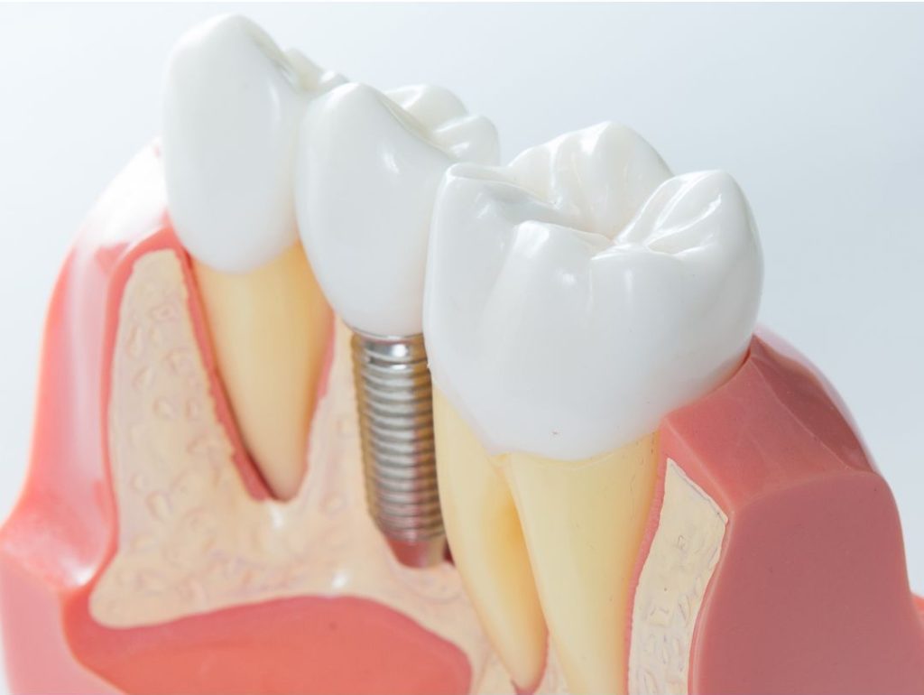 Implantes dentales