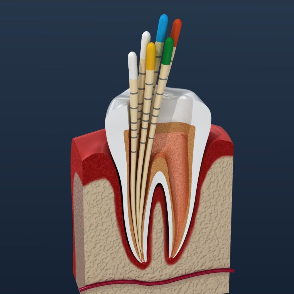 Endodoncia