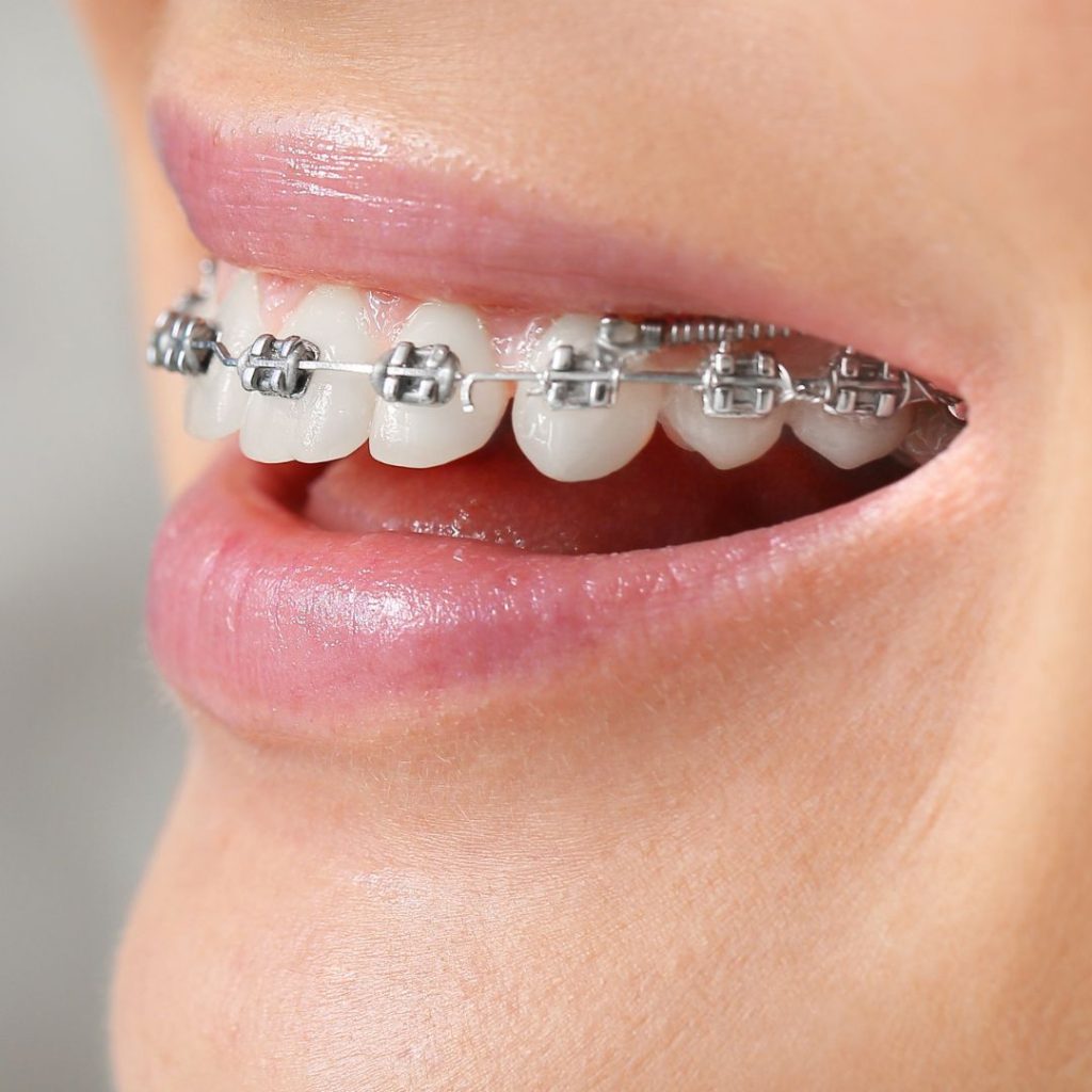 Foto Brackets