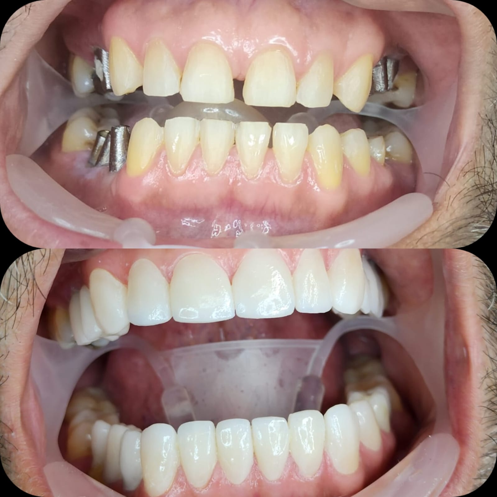 Implantes 3